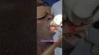 Cheeck abscess  drainage  i and d drainage of abscess  Dr Hitesh Patel [upl. by Eidnew]