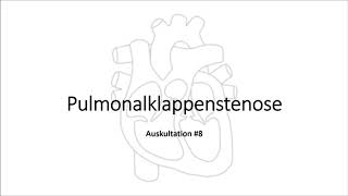 Auskultation 8 Pulmonalklappenstenose [upl. by Hemetaf]