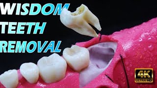 wisdom Tooth Removal  wisdom Tooth Aftercare [upl. by Giffie]