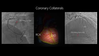 Coronary Collateral Circulation with Angiographic examples [upl. by Lavinie253]