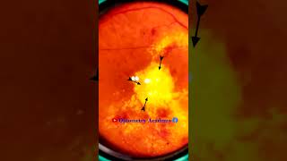 Diabetic retinopathy  Hemorrhages  Hard exudates  Fundus  Short Video 191 [upl. by Nigel]