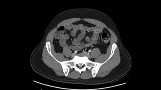 How to read a CT of the Abdomen and Pelvis  a quick practical approach axial [upl. by Ahoufe177]