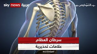 أعراض تشير لسرطان العظام في مراحله الأولى برنامجالتشخيص [upl. by Scotti]