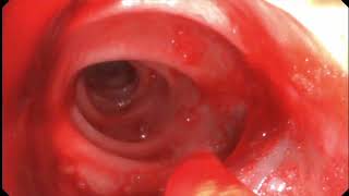 Hot snare polypectomy and postprocedural bleeding hemostasis [upl. by Roldan]