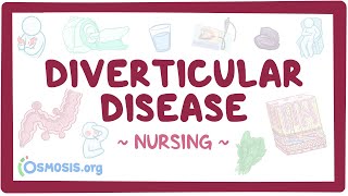 Diverticular disease Clinical Nursing Care [upl. by Amabel]