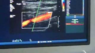 Carotid Doppler Scan [upl. by Ibib]