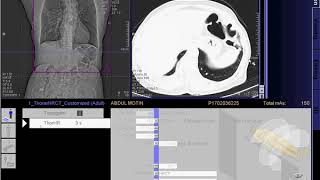 HRCT Scan of Chest full work quot SIEMENSquot [upl. by Ixela]