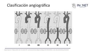 Arteritis de Takayasu [upl. by Odel]