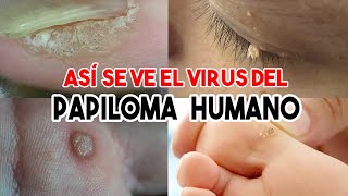 TODOS los tipos de VERRUGAS que causa el VIRUS DEL PAPILOMA HUMANO [upl. by Nina]