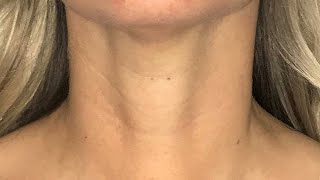 Scarless Thyroidectomy  Transoral Endoscopic Thyroidectomy Vestibular Approach [upl. by Sirromed]