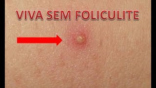 Foliculite Como Evitar [upl. by Scottie]