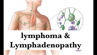 lymphoma amp lymphadenopathy pathology Hematologyamp Oncology Integrated lecture by ASM Minds Team [upl. by Heda]