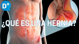 Hernias ¿Qué es una hernia y por qué se produce [upl. by Ilajna]