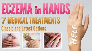 Eczema on Hands Treatment  7 Best Medical Treatment Options for Hand Dermatitis [upl. by Aciruam]