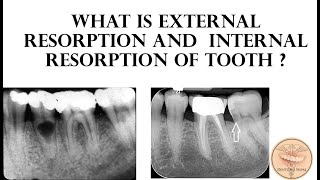 External Resorption and Internal Resorption of Tooth [upl. by Rafaelia]