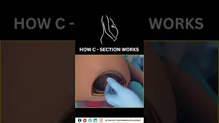 Cesarean Section Explained Why Doctors Choose CSections for a Safer Birth 👶✂️ Cesarean Birth [upl. by Obadias]