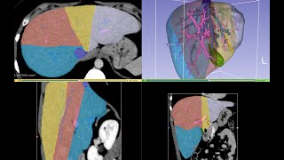 Organ segmentation 43  Liver segmentation and volumetry [upl. by Hennie]