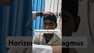 Horizontal NystagmusVestibular involvementmrmc medicine neurology medicaleducation Dr NeelRK [upl. by Namajneb703]