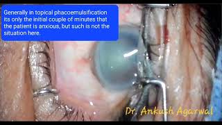 Topical phacoemulsification cataract surgery in a highly apprehensive patient with strong bells [upl. by Tol]