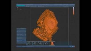 Ecografia 3D4D Making 3D4D ecography ultrasound SonoScape S11 [upl. by Benisch]