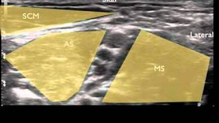 Ultrasound Guided Interscalene Nerve Block [upl. by Geraud]