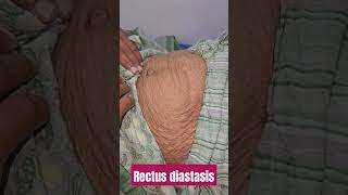 rectus diastasis imwell [upl. by Erika]