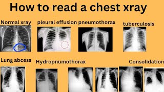 Normal chest xray pleuraleffusiontbxraychestxray [upl. by Sej867]