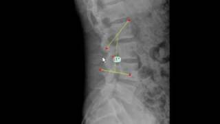 TraumaCad  Lumbar Lordosis Angle [upl. by Dich876]