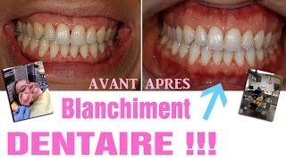 Blanchiment dentaire  AVANTAPRES Revue 25 [upl. by Oluas454]