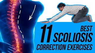 11 Easy Scoliosis Posture Correction Exercises [upl. by Ymas843]