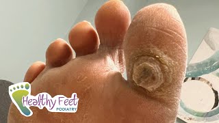 DEEP SATISFYING CALLUS TREATMENT [upl. by Sivi658]