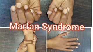 Marfan Syndrome  Clinical Signs [upl. by Eamaj872]