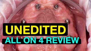 UNEDITED Allon4 Dental Implant Review [upl. by Eitak]