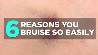 6 Reasons You Bruise So Easily  Health [upl. by Ahola]