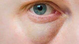 How to Cure Puffy Eyes  Under Eye Bags Home Remedies [upl. by Evander591]