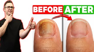 BEST Toenail Fungus Treatment 2024 4 BIG SECRETS [upl. by Cain]