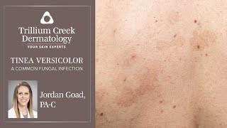 How to spot Tinea Versicolor a common fungal rash [upl. by Jacobs]