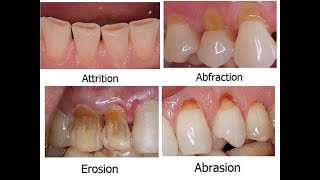 cervical lesion شرح [upl. by Velda]