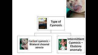 Cyanosis  Pediatrics [upl. by Yorker358]