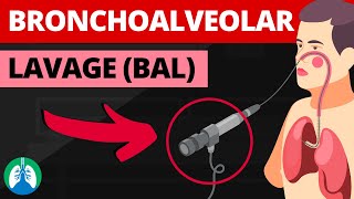 Bronchoalveolar Lavage BAL Medical Definition  Quick Explainer Video [upl. by Lienhard]