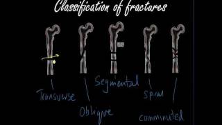 Classifying and presenting Fractures  Orthopaedics for Medical Students  Finals [upl. by Lirrehs]