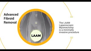 LAAM CIGC’s FastRecovery Laparoscopic Myomectomy [upl. by Nnylimaj]