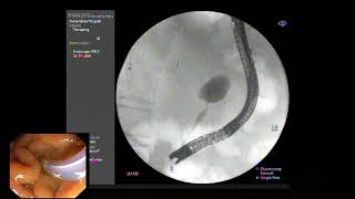 ERCP  EST with SEMS placement for mid CBD stricture from advance pancreatic cancer [upl. by Suiramed683]