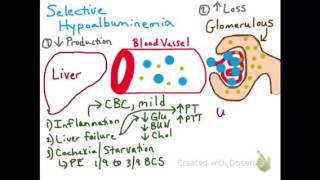 Selective Hypoalbuminemia [upl. by Elbon]