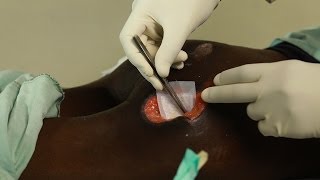 Maggot Debridement Therapy in Kenya KARITRC Documentary [upl. by Enorel121]