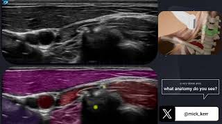 The brachial plexus anatomy sonoanatomy  above the clavicle [upl. by Taran134]