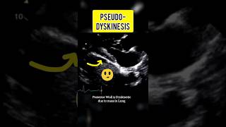 Pseudo Dyskinesia shorts trending echocardiography heartdisease cardiology [upl. by Akirrehs]