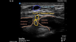 Interscalene catheter [upl. by Kosse995]