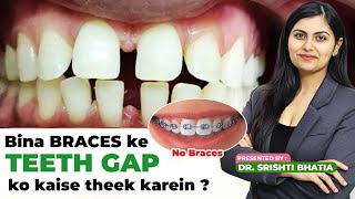 BINA BRACES ke TEETH GAP jaldi kaise theek kren Dr Srishti Bhatia teeth smile teethgapmakeover [upl. by Giraldo]