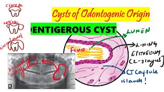 Dentigerous cyst  HISTOPATHOLOGY Clinical  etiopathology DETAILED  Cysts of odontogenic origin [upl. by Deva4]